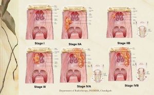 Các giai đoạn của bệnh ung thư vòm họng