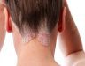 Triệu chứng của bệnh ung thư da đầu giai đoạn đầu như thế nào?