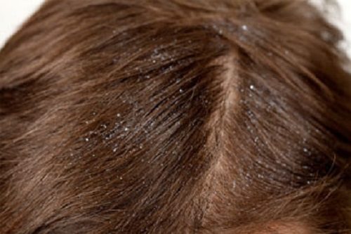 Gàu xuất hiện nhiều cũng là một triệu chứng của ung thư da đầu.