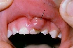 Sưng nướu dài lâu là dấu hiệu rõ ràng của bệnh ung thư răng miệng