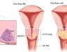 Ung thư buồng trứng: Dấu hiệu nguyên nhân, chữa Ung thư buồng trứng