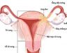 Ung thư buồng trứng di căn ổ bụng căn bệnh nguy hiểm của phụ nữ