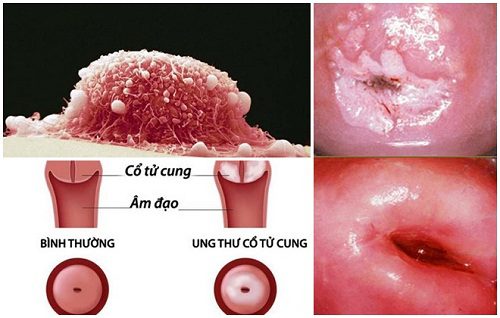 Ung thư cổ tử cung giai đoạn 1a gây ra bởi virut HPV