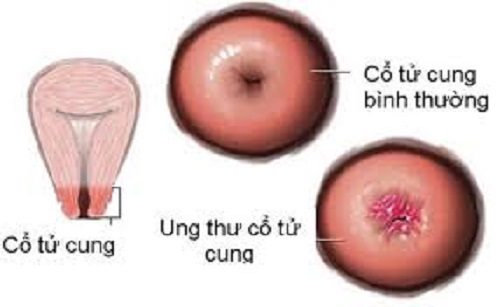 Biến dạng cổ tử cung ở ung thư cổ tử cung giai đoạn 1b1.
