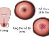Ung thư cổ tử cung giai đoạn 2b: Nguyên nhân, dấu hiệu và cách điều trị