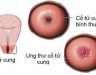 Ung thư cổ tử cung giai đoạn 3b, dấu hiệu và phương pháp điều trị