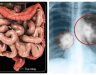 Ung thư đại tràng di căn sang phổi: Triệu chứng và phương pháp điều trị