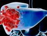 Ung thư gan nên ăn uống như thế nào? Uống gì chữa ung thư gan?