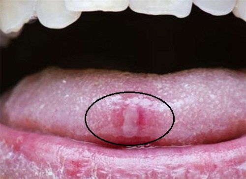 Bệnh ung thư lưỡi có thể chữa khỏi nếu được phát hiện và chữa trị sớm
