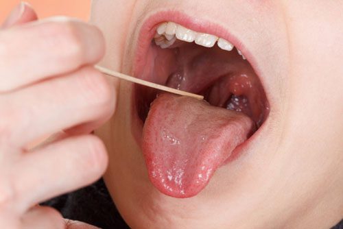 Nguyên nhân gây ung thư lưỡi do sử dụng chất kích thích