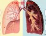 Tầm soát ung thư phổi ở đâu Hà Nội đảm bảo và giá cả hợp lí nhất?