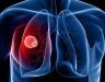 Một số triệu chứng và các bài thuốc chữa ung thư phổi hiệu quả