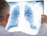 Điều trị ung thư phổi di căn xương cùng đặc điểm và biến chứng