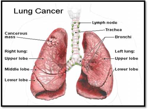 Bệnh ung thư phổi di căn gan bắt đầu từ các khối u ung thư ở phổi