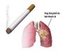 Các giai đoạn của ung thư phổi biệu hiện triệu chứng như thế nào?
