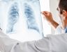 Ung thư thực quản di căn phổi là gì? Cách điều trị và phòng ngừa