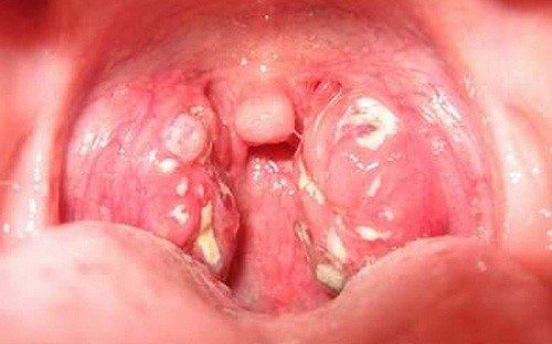 Ung thư vòm họng phát triển nhanh