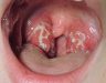 Hình ảnh bệnh ung thư vòm họng và những vấn đề liên quan   