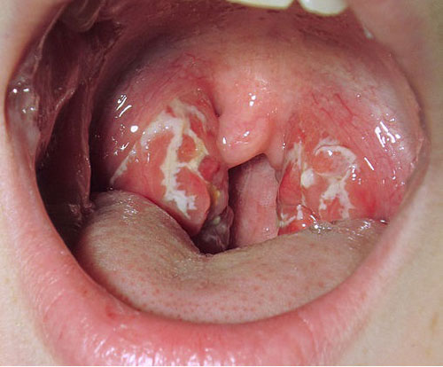 Hình ảnh bệnh ung thư vòm họng thể chính xác các giai đoạn của bệnh