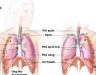 Điều trị ung thư phổi giai đoạn 2 có khả thi không?