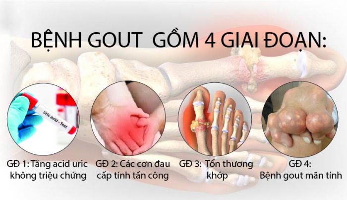 Các giai đoạn tiến triển của bệnh gout