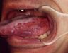 8 dấu hiệu nhận diện ung thư lưỡi và cách phòng bệnh hiệu quả