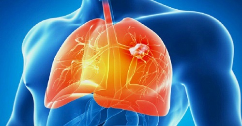 Bài thuốc chữa ung thư phổi được lan truyền chóng mặt