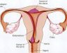 Giai đoạn đầu của ung thư cổ tử cung: Biểu hiện, cách điều trị