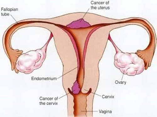 Biểu hiện giai đoạn đầu của ung thư cổ tử cung
