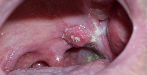 Chữa ung thư vòm họng giai đoạn cuối