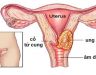 Dấu hiệu của bệnh ung thư cổ tử cung và nguyên nhân gây bệnh