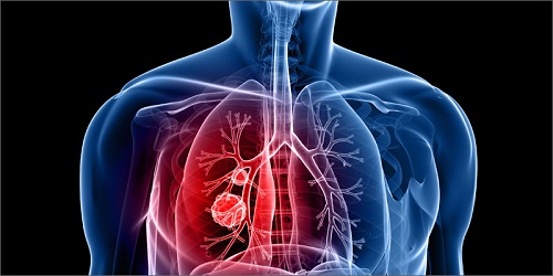 Điều trị ung thư phổi giai đoạn cuối bằng hóa trị