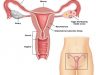 Dấu hiệu nhận biết ung thư cổ tử cung và cách phòng tránh