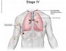 Hình ảnh ung thư phổi giai đoạn cuối và dấu hiệu nhận biết bệnh