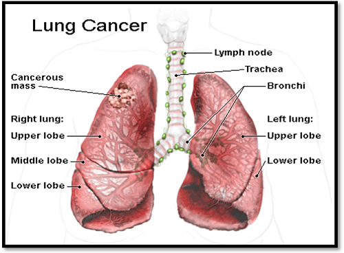 Triệu chứng của ung thư phổi di căn