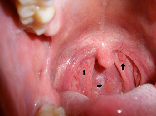 ung thư vòm họng giai đoạn đầu