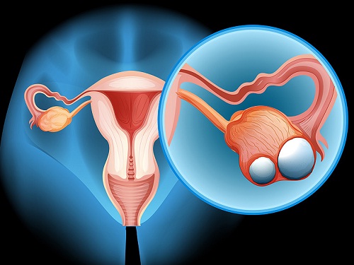 Ung thư buồng trứng giai đoạn 3 gây nên các dấu hiệu rối loạn kinh nguyệt