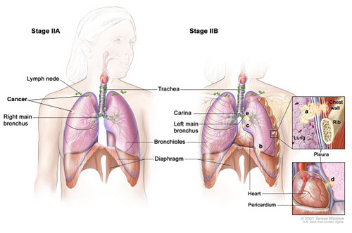 Đối với ung thư phổi thì ung thư giai đoạn 2 có chữa được không?