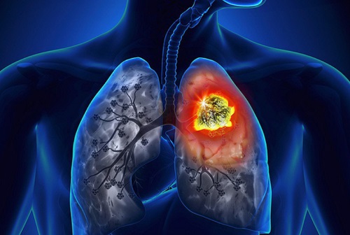 Bệnh ung thư phổi