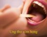 Bài thuốc trị ung thư vòm họng hiệu quả bạn không nên bỏ qua