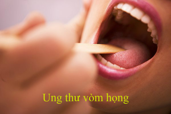 Ung thư vòm họng có thể điều trị bằng thuốc Nam