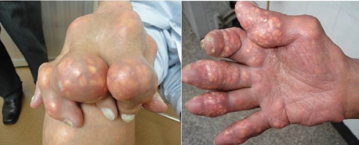 Bệnh gout giai đoạn 4 với các hạt tophi (hạt mềm) dưới da