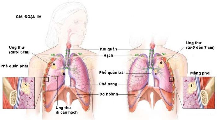 Bệnh ung thư phổi di căn sang nhiều bộ phận khác