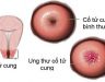 Bệnh ung thư cổ tử cung giai đoạn 1: Biểu hiện và cách điều trị