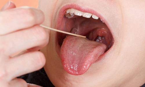 Bệnh ung thư lưỡi có di truyền không?