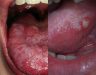 Bệnh ung thư lưỡi giai đoạn cuối: Biểu hiện và cách chữa trị