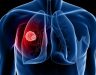 Bệnh ung thư phổi có chữa được không? Cách điều trị bệnh K phổi