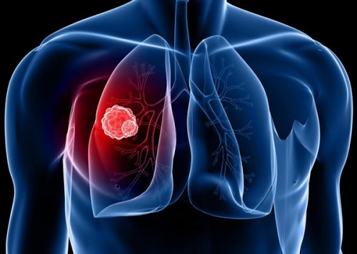 Bệnh ung thư phổi có chữa được không