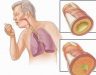 Bệnh ung thư phổi giai đoạn đầu có triệu chứng gì? Cách chữa bệnh