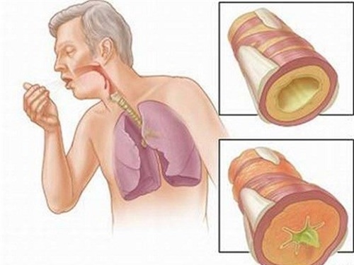 Bệnh ung thư phổi giai đoạn đầu có triệu chứng ra sao
